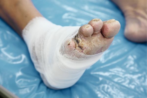 Tratamiento de Pie Diabetico